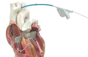 OmniaSecure becomes first defibrillation lead to receive US FDA approval for conduction system pacing