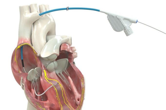 OmniaSecure becomes first defibrillation lead to receive US FDA approval for conduction system pacing