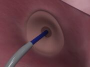 Protaryx Medical receives US FDA clearance for proprietary transseptal puncture device