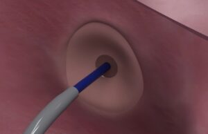 Protaryx Medical receives US FDA clearance for proprietary transseptal puncture device