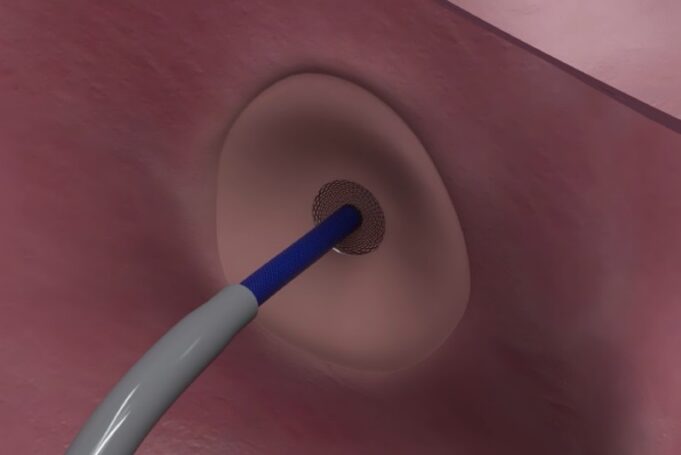 Protaryx Medical receives US FDA clearance for proprietary transseptal puncture device